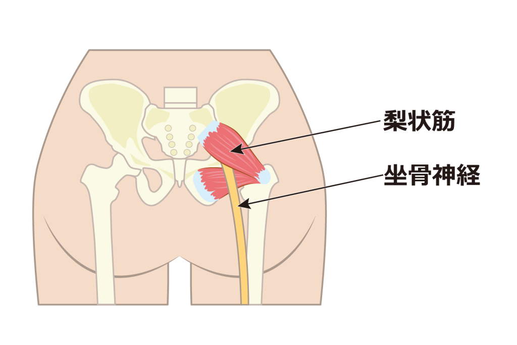 坐骨神経痛